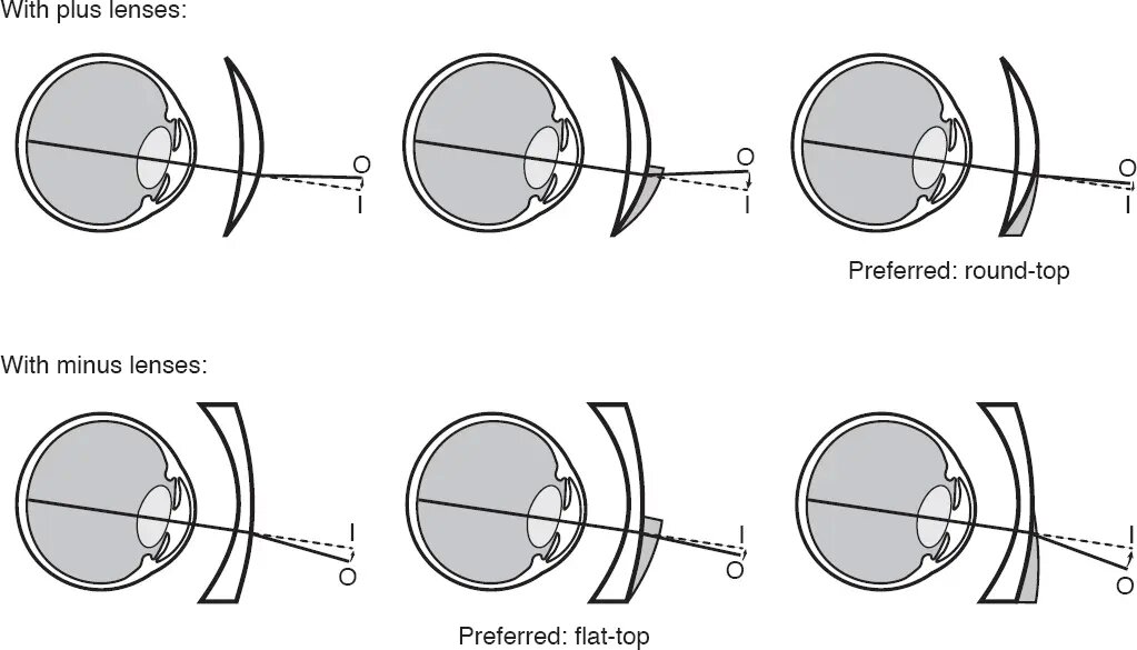 bifocal planae summo circum vertice lens